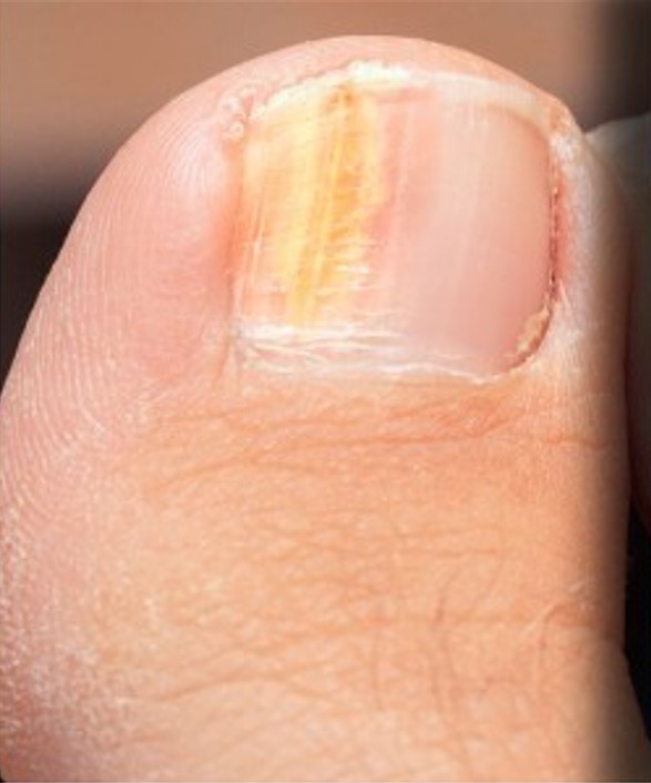 AppaNail Stock Toe 1 - yellow spot